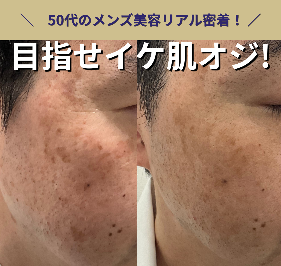 メンズのシミ治療、経過報告！