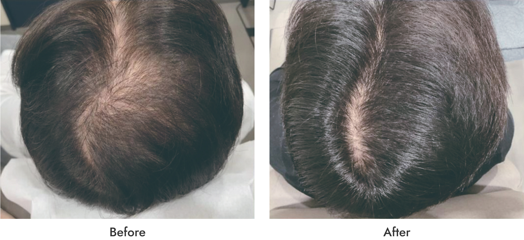 DR.CYJヘアフィラー8回・ザガーロ内服